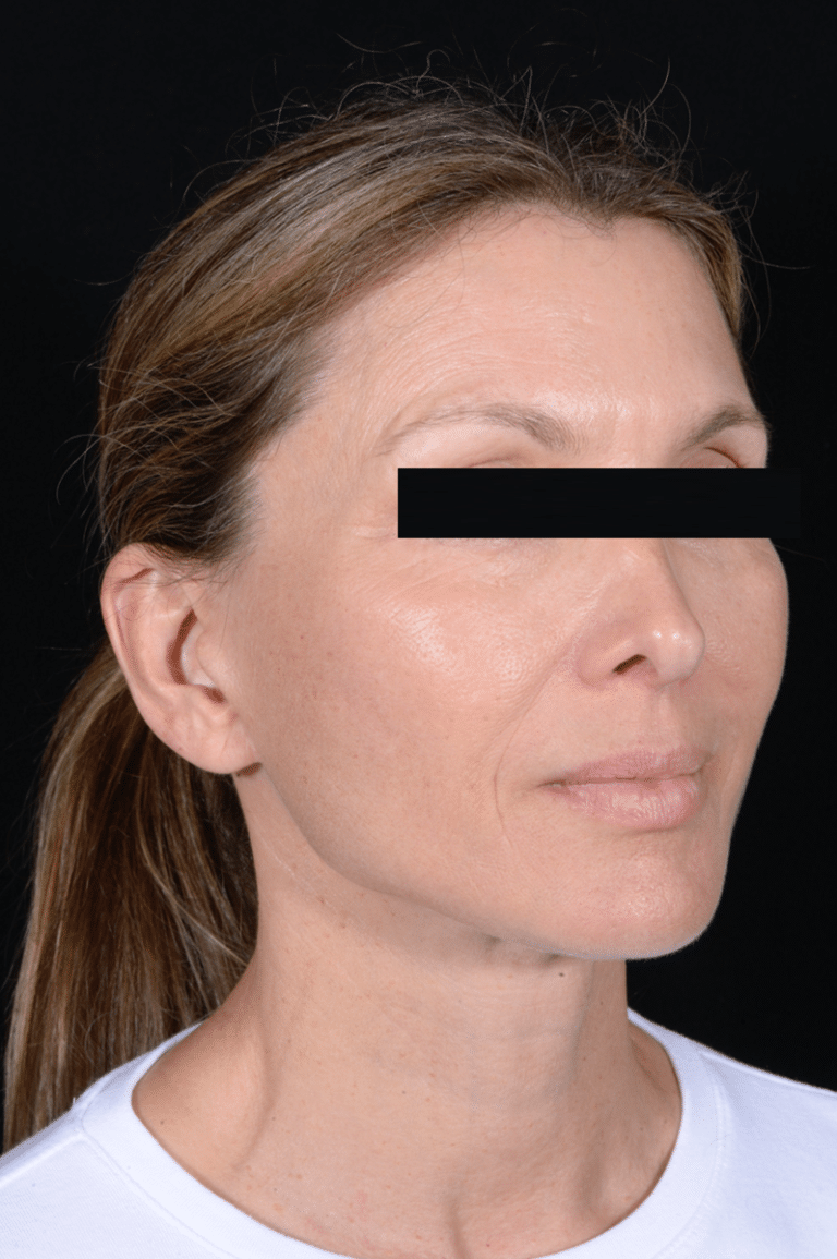 After Image: Facelift - right-front-oblique