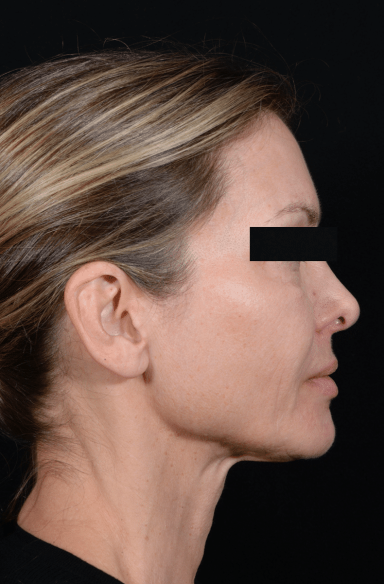 Before Image: Facelift - right-side