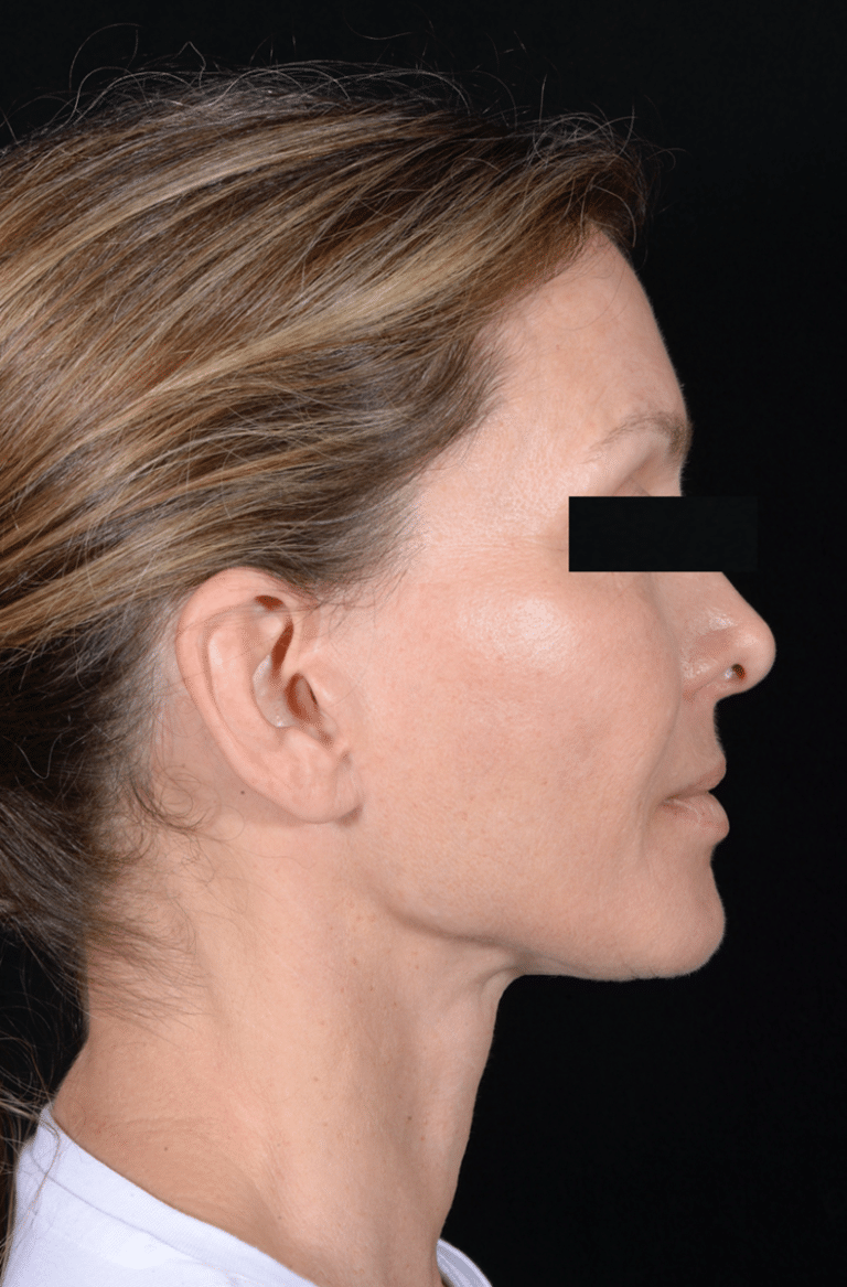 After Image: Facelift - right-side
