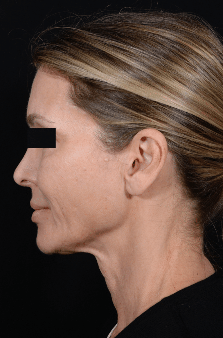 Before Image: Facelift - left-side