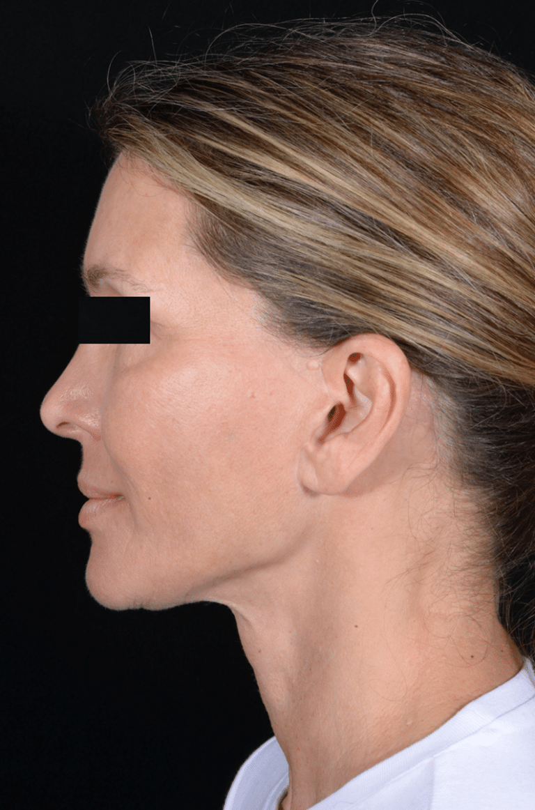 After Image: Facelift - left-side