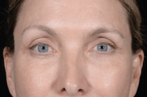 After Image: Blepharoplasty