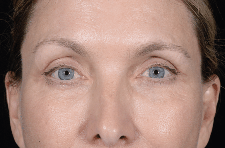 After Image: Blepharoplasty - front