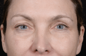 Before Image: Blepharoplasty