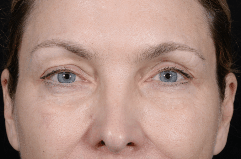 Before Image: Blepharoplasty - front
