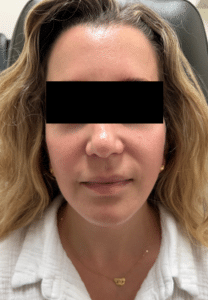 After Image: Facelift
