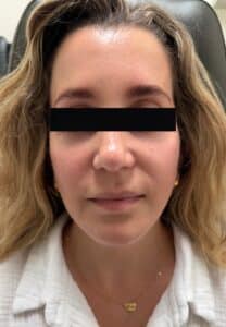 After Image: Facelift