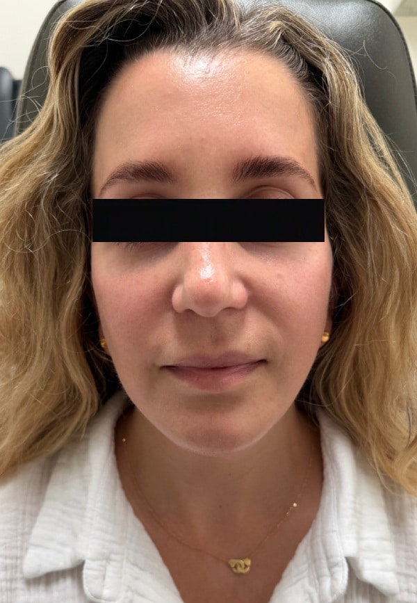 After Image: Facelift - front
