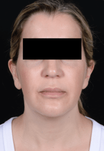 Before Image: Facelift
