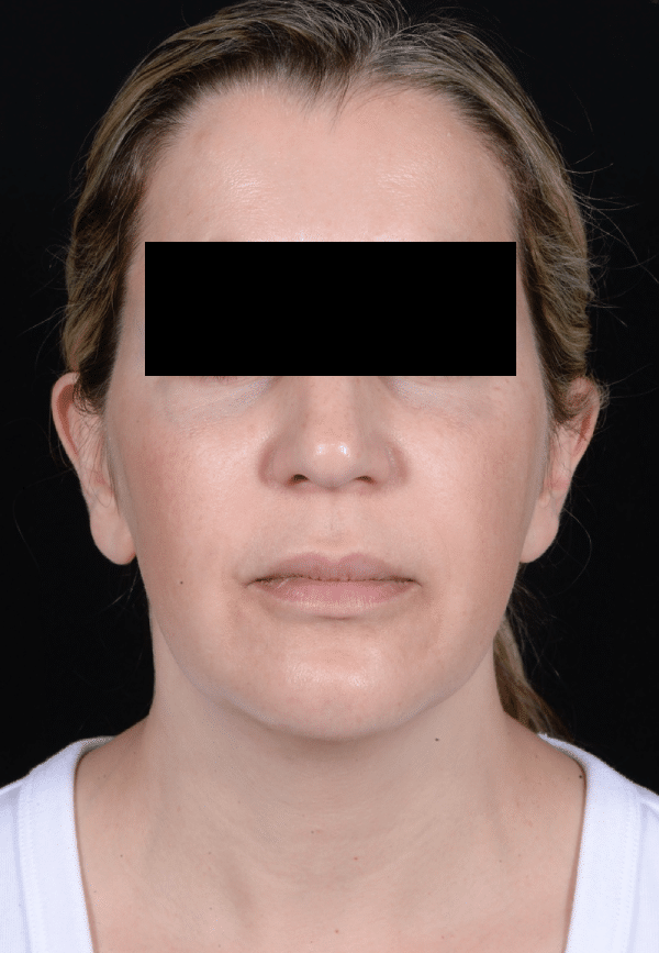 Before Image: Facelift - front
