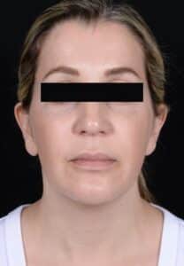 Before Image: Facelift