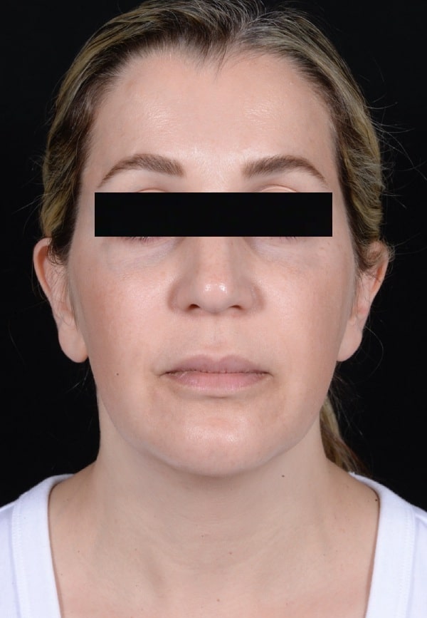 Before Image: Facelift - front