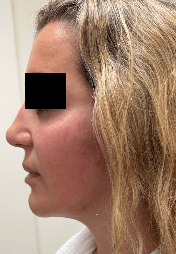 After Image: Facelift - left-side