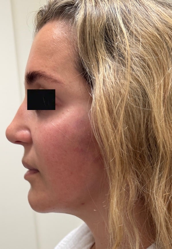 After Image: Facelift - left-side