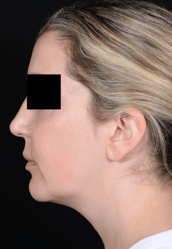 Before Image: Facelift - left-side