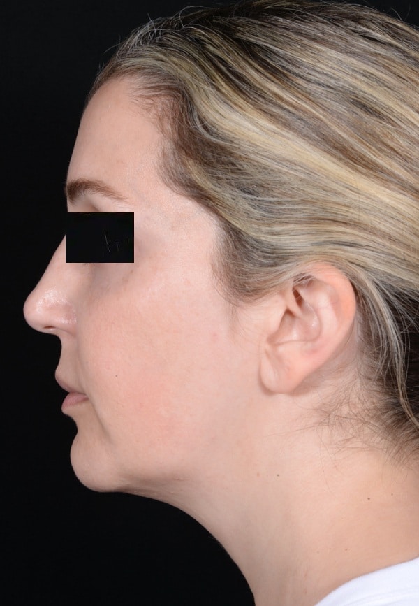 Before Image: Facelift - left-side
