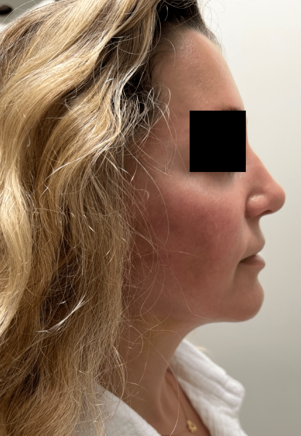 After Image: Facelift - right-side