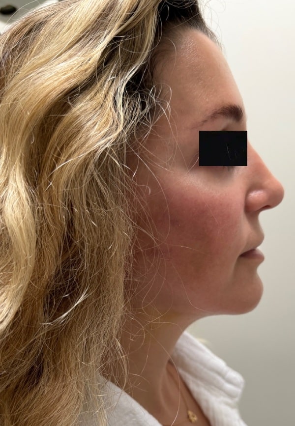After Image: Facelift - right-side