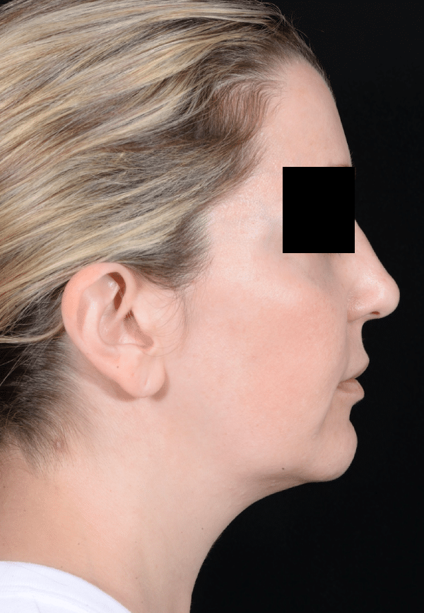 Before Image: Facelift - right-side
