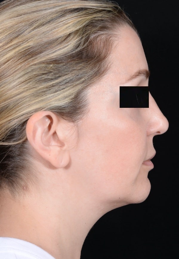 Before Image: Facelift - right-side