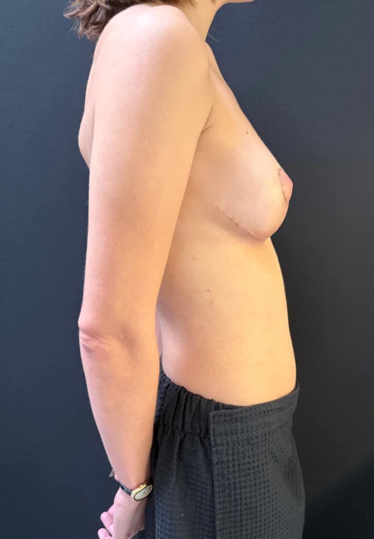 After Image: Breast Lift - right-side