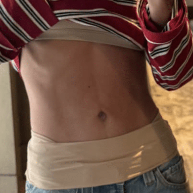 After Image: Umbilicoplasty - front