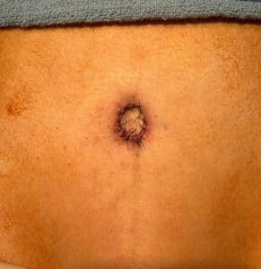 After Image: Umbilicoplasty