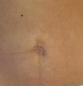 Before Image: Umbilicoplasty