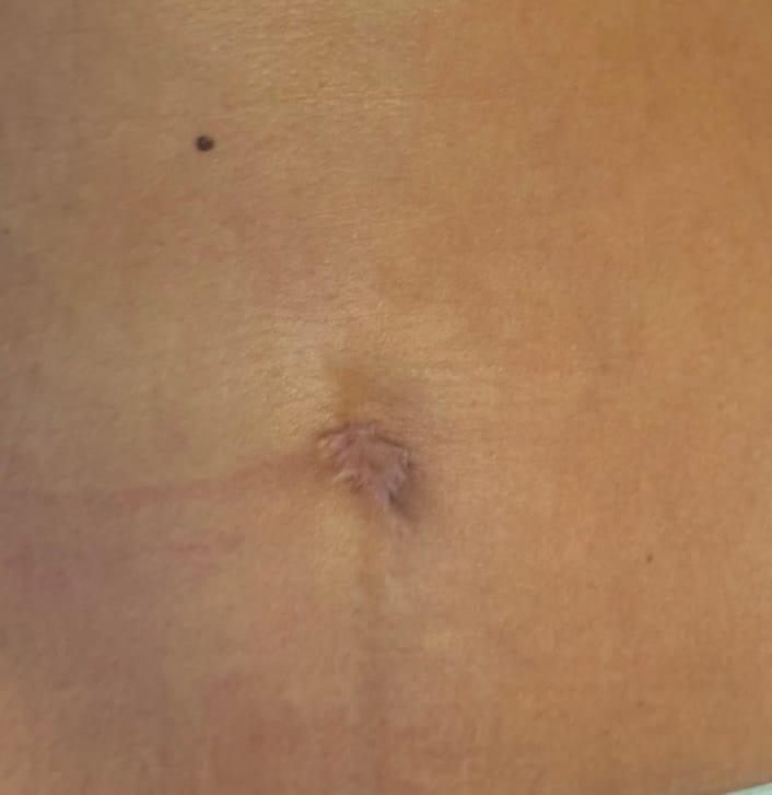 Before Image: Umbilicoplasty - front