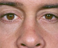 Blepharoplasty