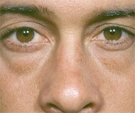 Blepharoplasty