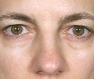 Blepharoplasty