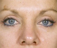 Blepharoplasty