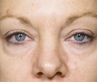 Blepharoplasty