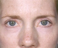 Blepharoplasty