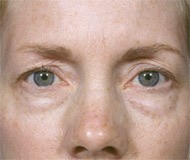 Blepharoplasty