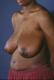 Breast Reduction