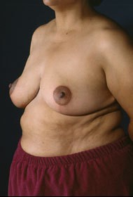 Breast Reduction