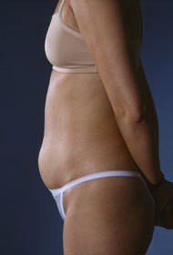 Liposuction