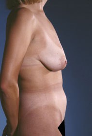 Liposuction