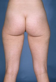 Liposuction