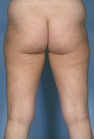 Liposuction