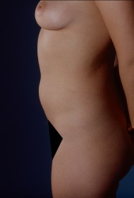 Before Image: Liposuction - left-side