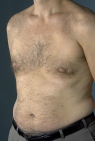 Male Breast Reduction (Gynecomastia)