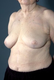 Breast Revision