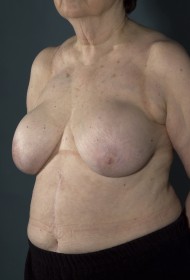 Breast Revision