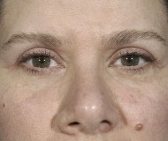 Blepharoplasty