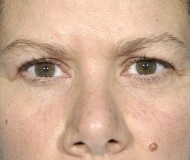 Blepharoplasty