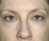 Blepharoplasty