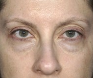 Blepharoplasty